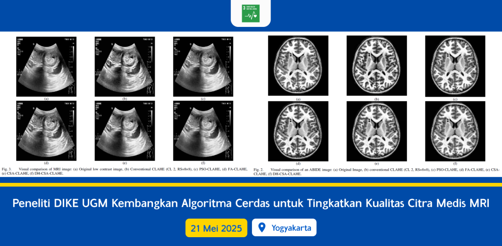 Peneliti DIKE UGM Kembangkan Algoritma Cerdas untuk Tingkatkan Kualitas Citra Medis MRI